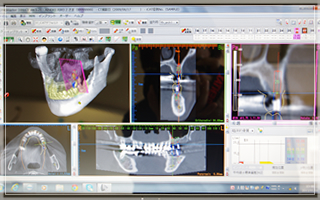 インプラントシュミレーションソフト